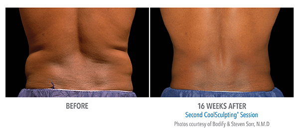 Images of Before and after 16 weeks of results of CoolSculpting session in Cleveland, OH 