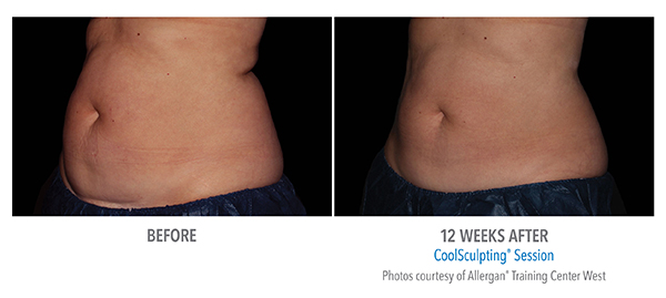 Amazing before and after 12 weeks results of CoolSculpting in Cleveland area