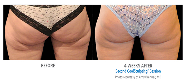 Before and after 4 weeks of CoolSculpting Session in Cleveland