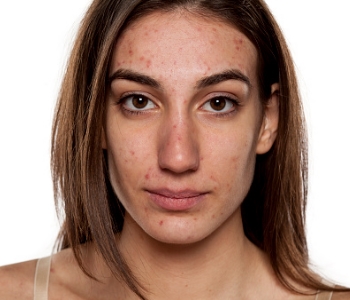 girl with acne scars on her face