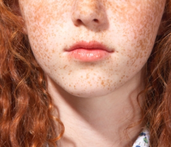 freckles on red headed woman's face