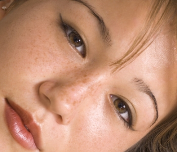 melasma on womans face, treatments for melasma in cleveland