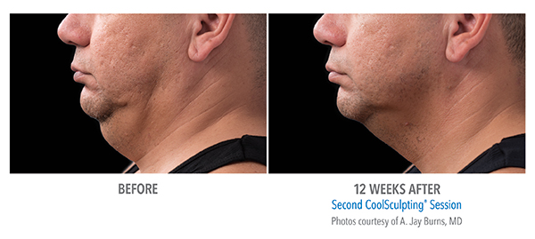 Before and after 12 weeks results of CoolSculpting for double chin removal in Cleveland, OH