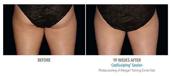 Before and after the treatement of CoolSculpting,  amazing results after 19 weeks in Cleveland area