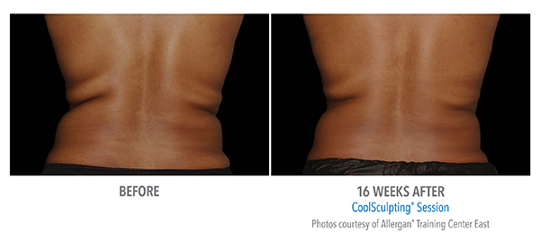Images of Before and after 16 weeks of CoolSculpting procedure  in Cleveland, OH
