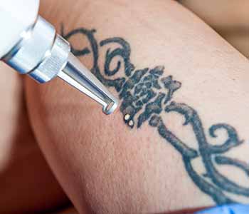 Patients in the Chagrin Falls, OH area who are interested in having laser tattoo removal performed are welcome to visit Seriously Skin to discuss the advantages of treatment by our quality team.