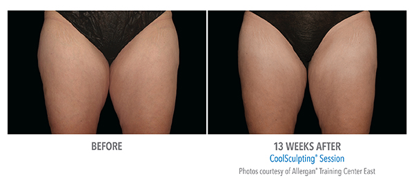Before and after 13 weeks amazing results of CoolSculpting session  in Cleveland, OH