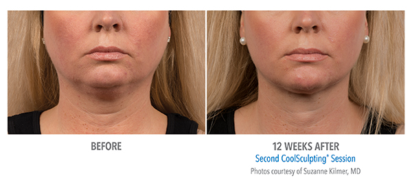 Image of Before and after 12 weeks of CoolSculpting session in Cleveland, OH